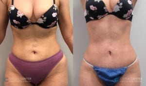 Patient 8 Before and After Front View