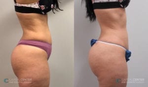 Patient 8 Before and After Side View