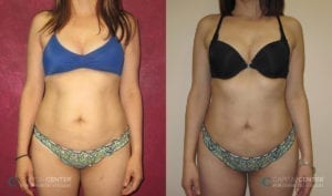 Patient 10 Lipo and BBL Before and After Back Front View