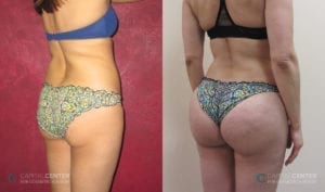 Patient 10 Lipo and BBL Before and After Back Oblique View