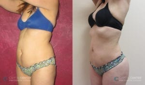 Patient 10 Lipo and BBL Before and After Front Oblique View